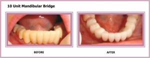 10 Unit Mandibular Bridge 