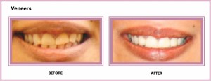 Veneers Gum Contouring  